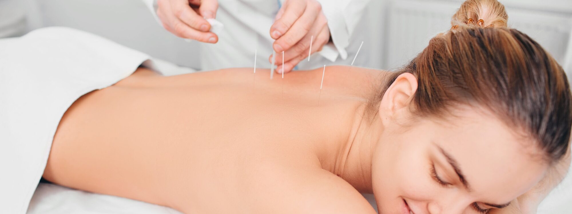 Client having acupuncture treatment on her back